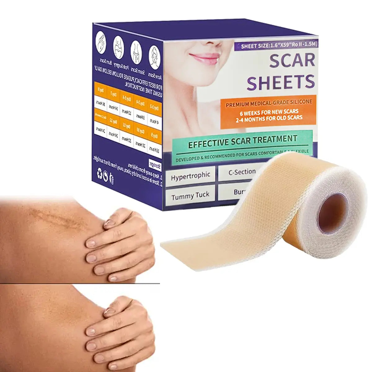 2026 Upgrade Silicone Scar Tepe for C-Section, Acne, Buruns & Keloids - Hypoallergenic Scar Care Sheets, Fast Healing, Suitable for All Skin Tayes (1.6"X 59" Roll-1.5M)