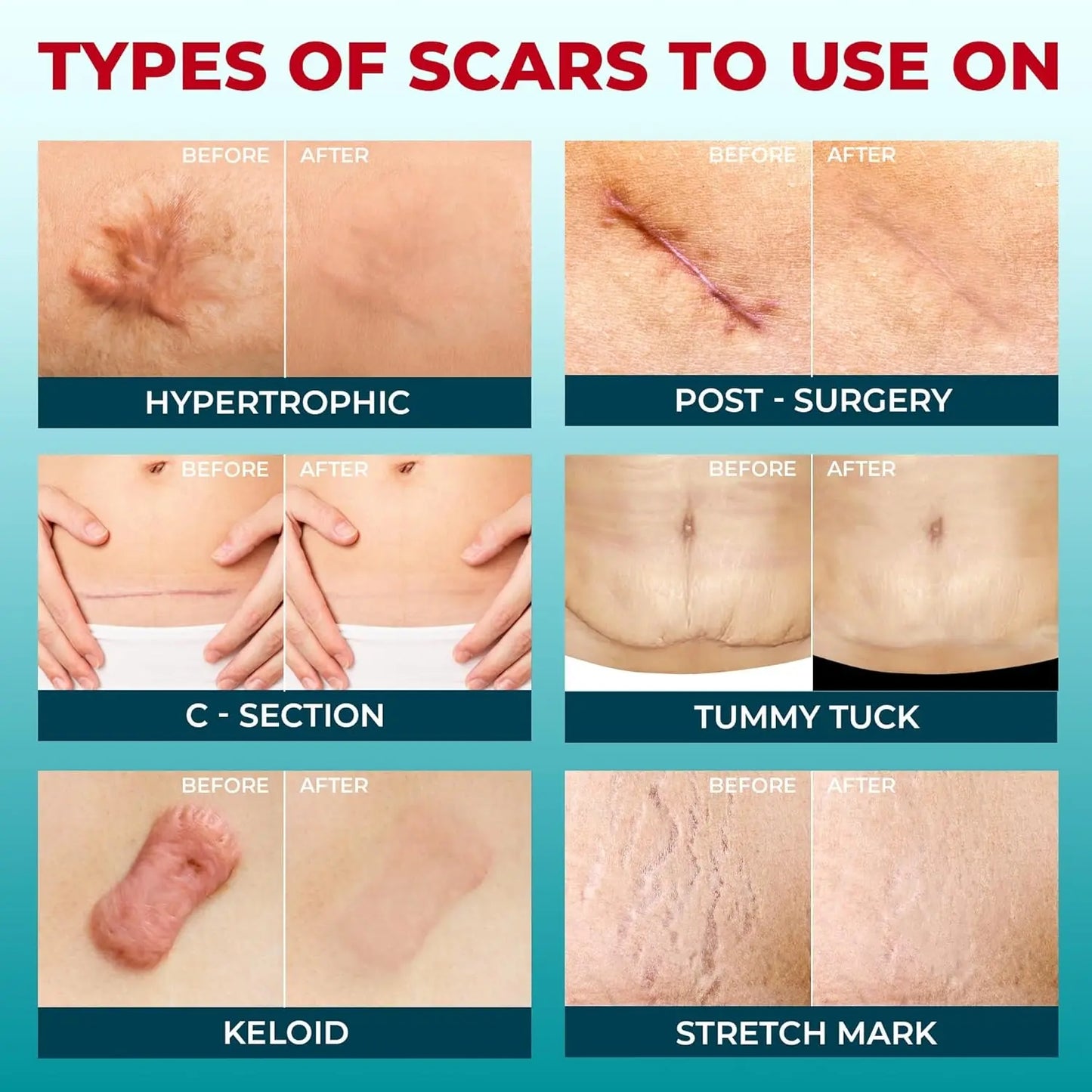 2026 Upgrade Silicone Scar Tepe for C-Section, Acne, Buruns & Keloids - Hypoallergenic Scar Care Sheets, Fast Healing, Suitable for All Skin Tayes (1.6"X 59" Roll-1.5M)