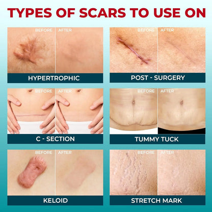2026 Upgrade Silicone Scar Tepe for C-Section, Acne, Buruns & Keloids - Hypoallergenic Scar Care Sheets, Fast Healing, Suitable for All Skin Tayes (1.6"X 59" Roll-1.5M)